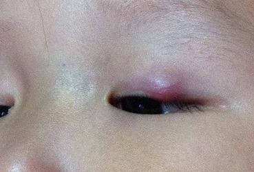 霰粒肿可以吃哈密瓜,天然食疗新选择